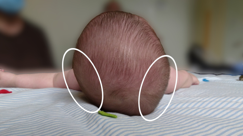 plagiocefalia bebé